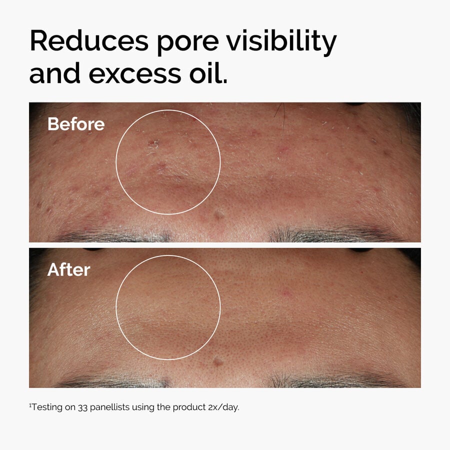 niacinamide-10-zinc-1-g6 ord-niacinamide-zinc-blemish-serum-before-after-pores.jpg