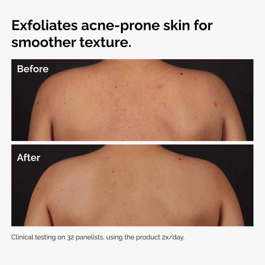 salicylic-acid-0-5-body-serum-l1 ord-salicylic-acid-body-serum-before-after-graphic-NA.jpg