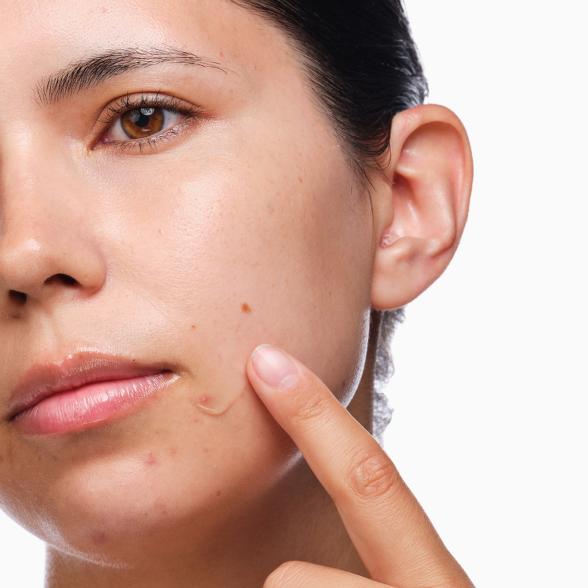 the-acne-set-b4 rdn-the-acne-set-application.png